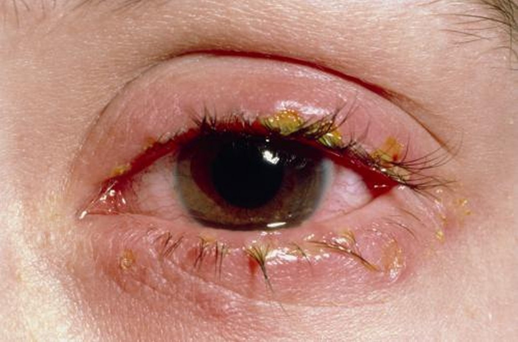 Acute Blepharitis