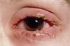 Akute Blepharitis