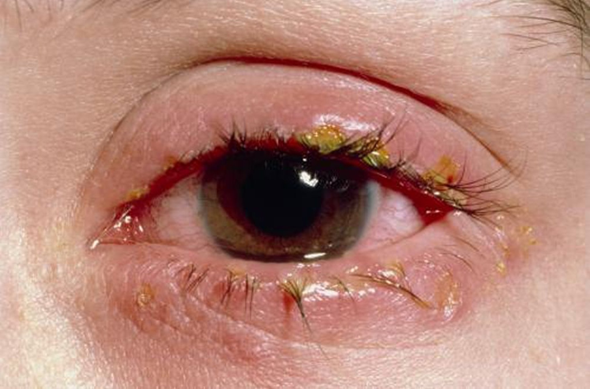 Akute Blepharitis