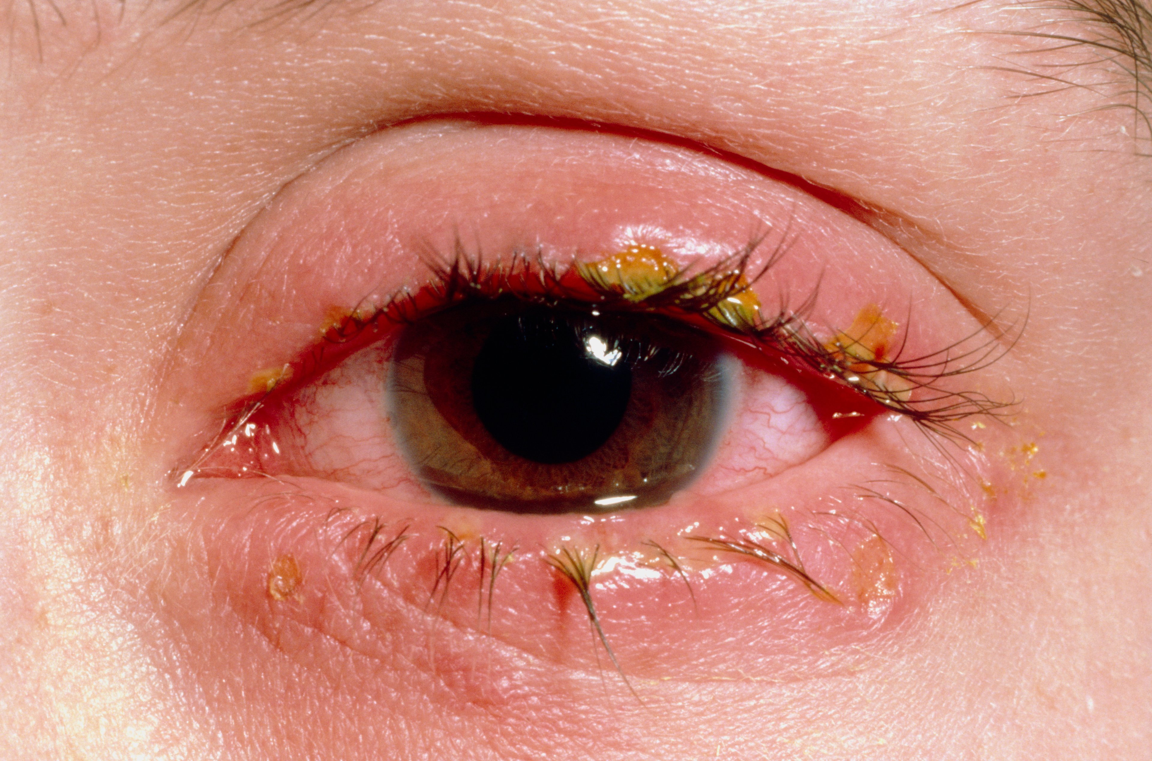 急性眼瞼炎