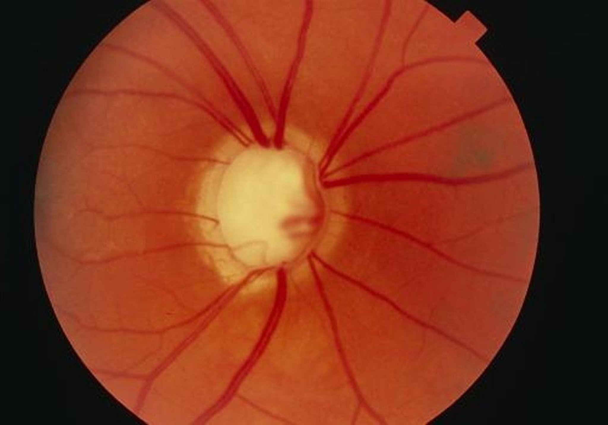 Glaucoma (Advanced)