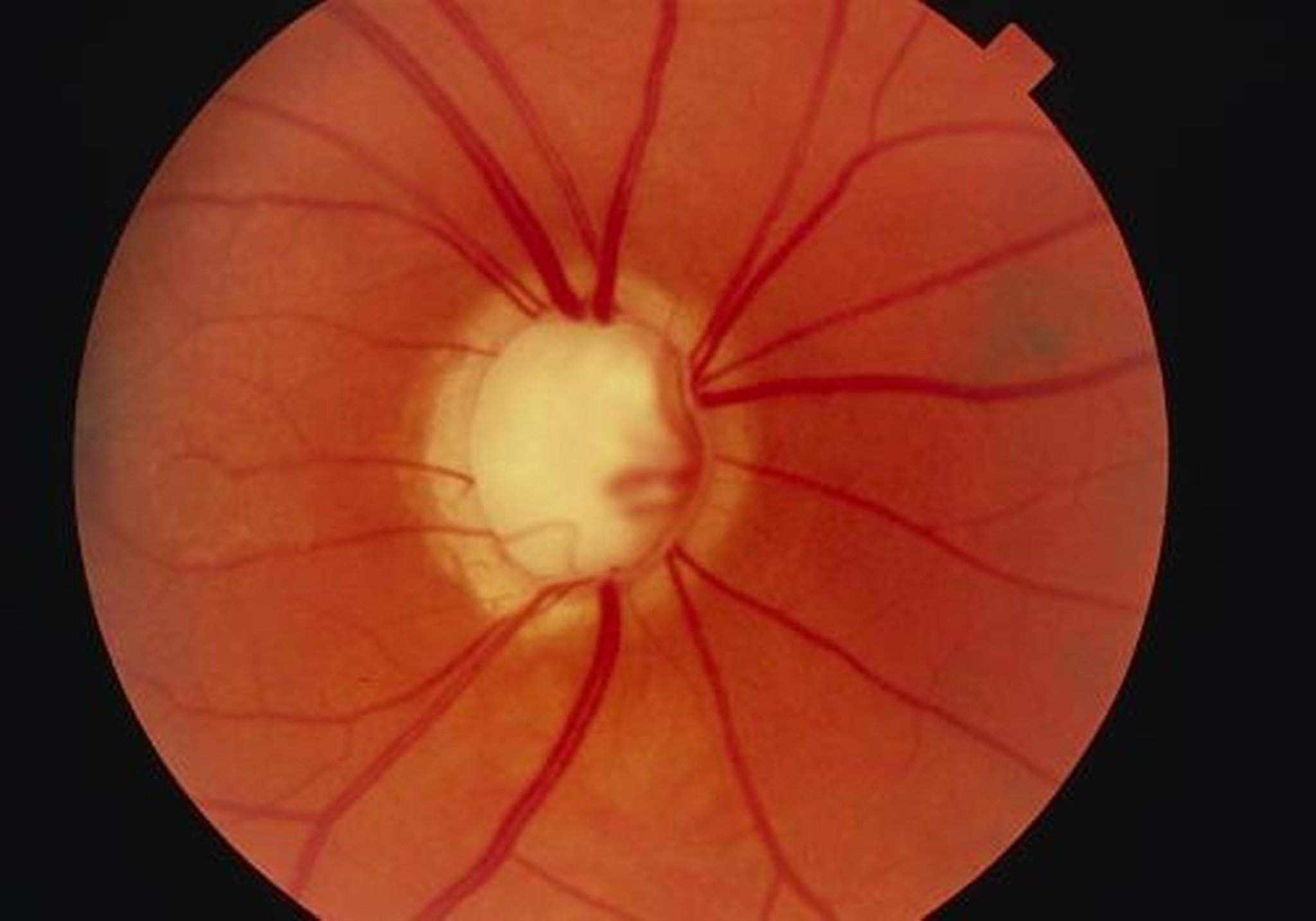 Glaucoma (avanzado)