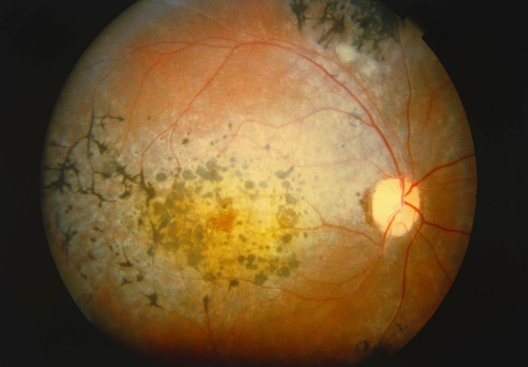 Retinitis Pigmentosa