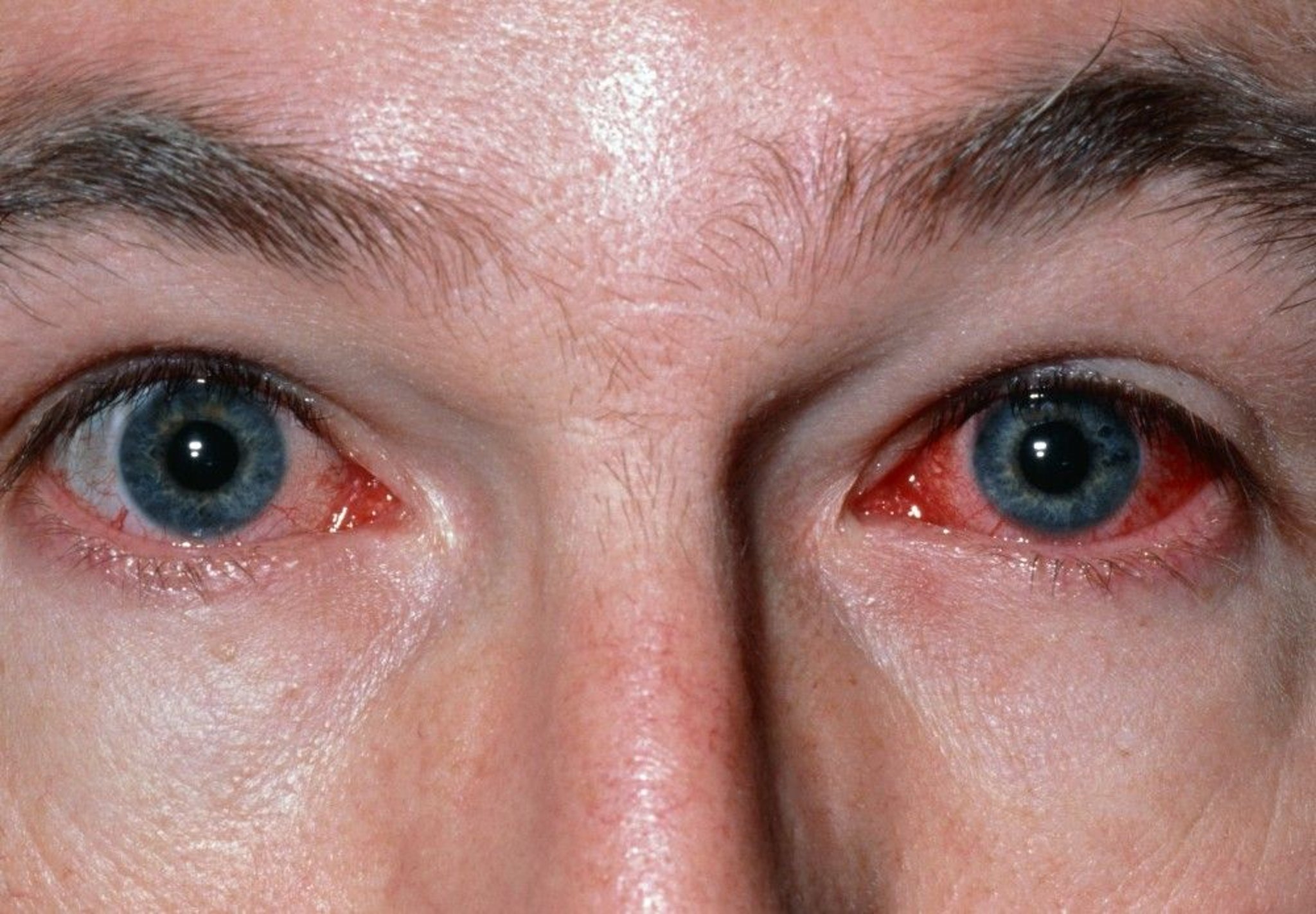 Viral Conjunctivitis
