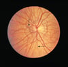 Pseudoxantoma elástico (estrias angioides)