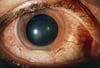 Maladie de Behçet (hypopyon)