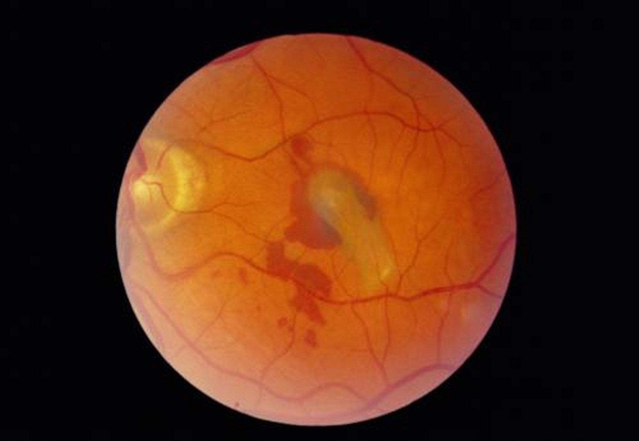 Retinal Detachment