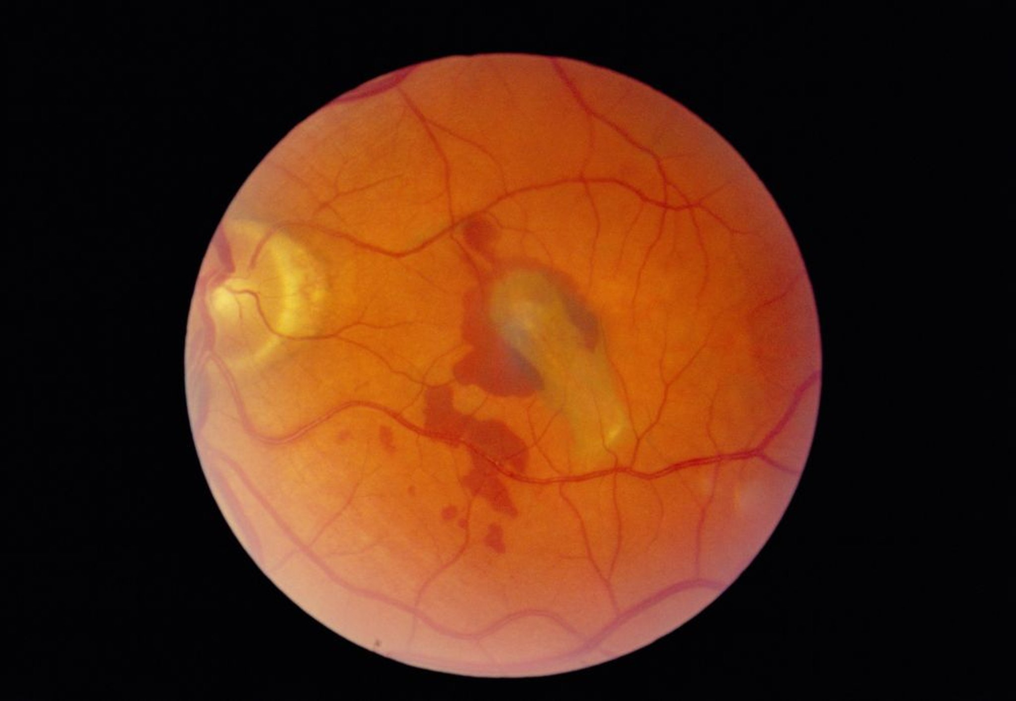 Desprendimiento de retina