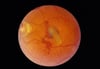 Distacco di retina