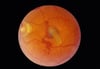 Descolamento da retina