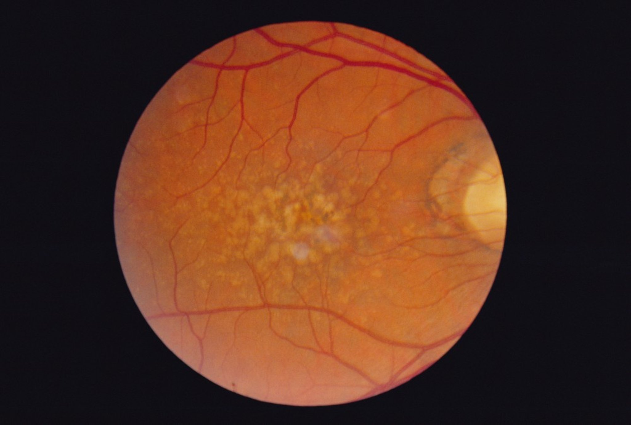 Age-Related Macular Degeneration (Dry, Intermediate With Drusen)