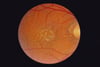 Degeneración macular asociada con la edad (seca, intermedia con drusas)