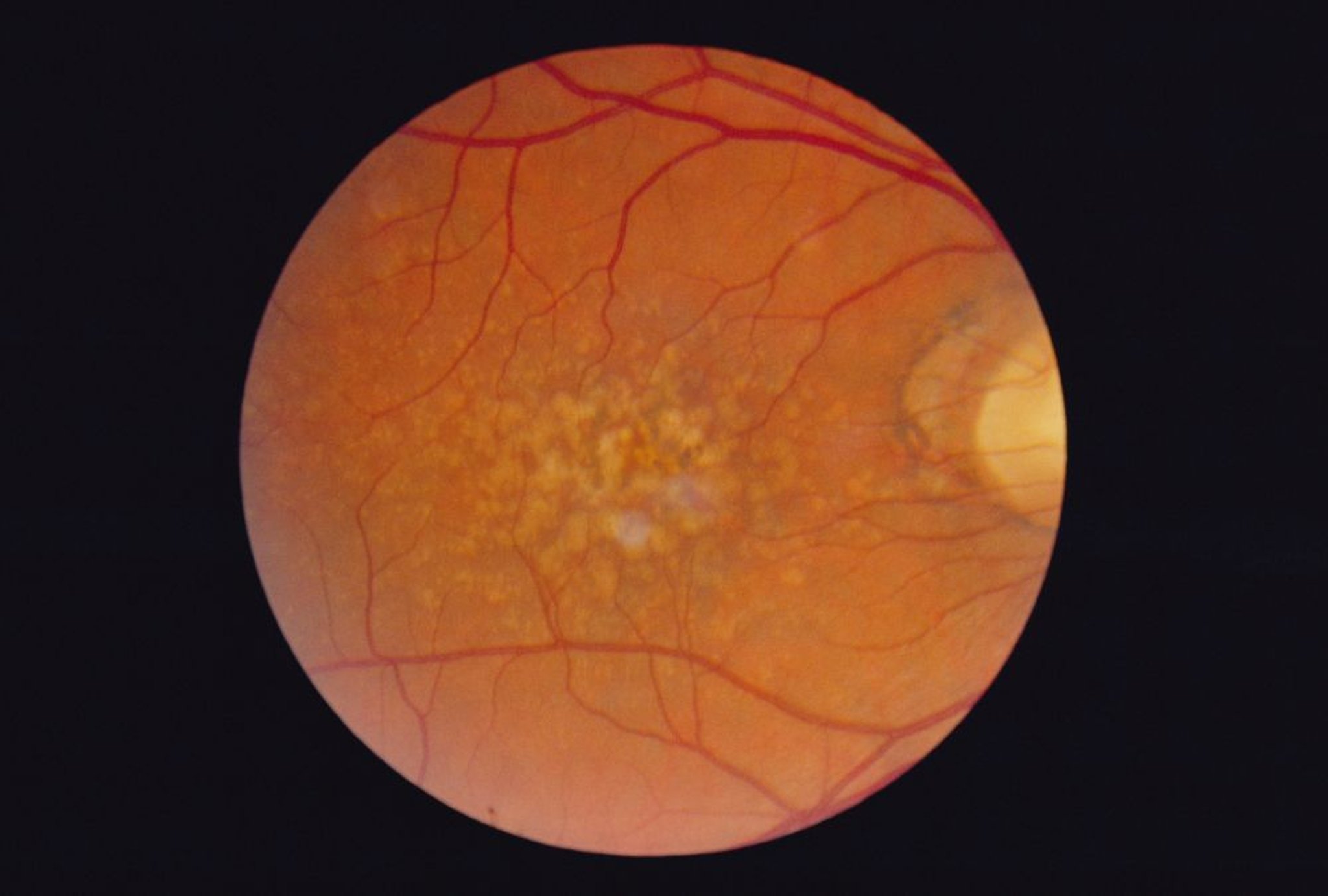 Degeneração macular relacionada com a idade (seca, intermediária com drusas)
