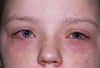 Conjuntivitis alérgica