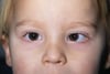 Strabismus (Esotropie)