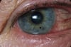 Cuerpo extraño en el ojo