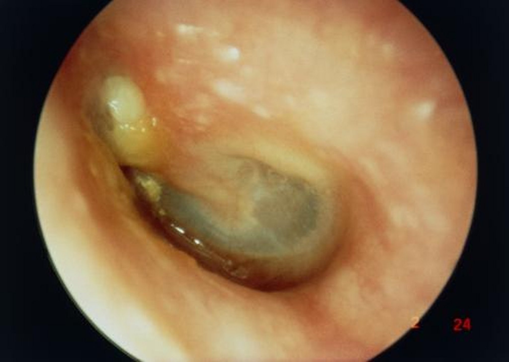 Cholesteatoma