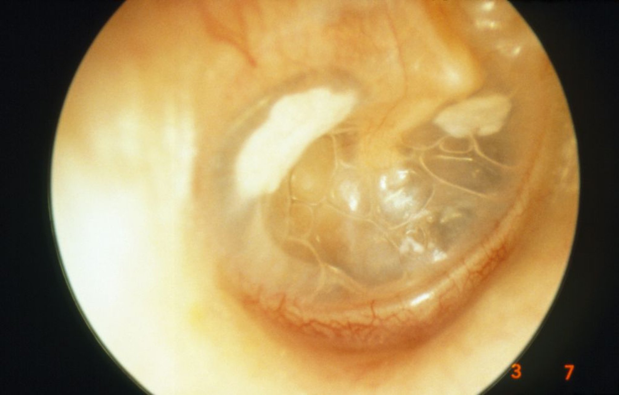 Otitis media perforada