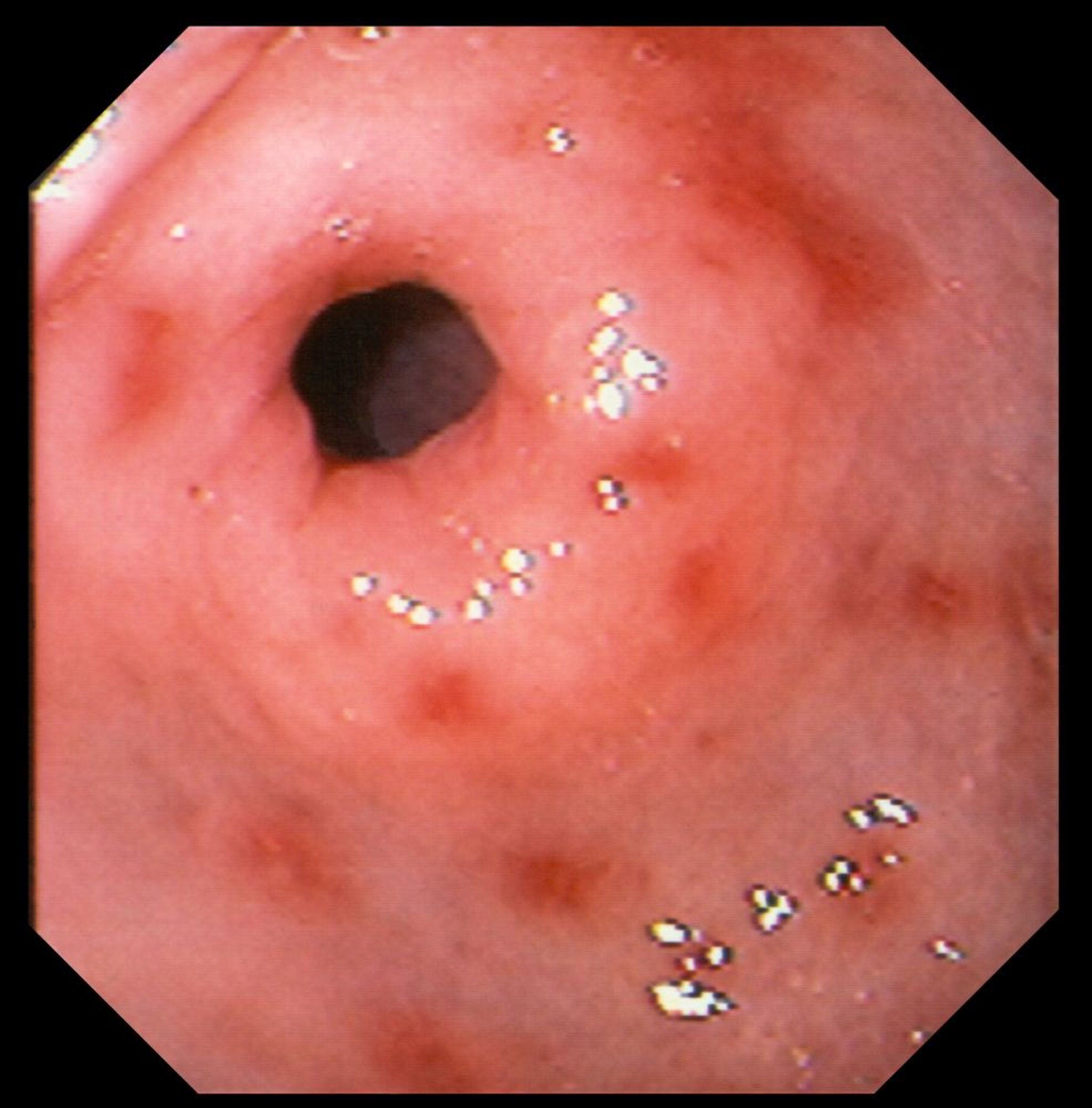 Erosive Gastritis