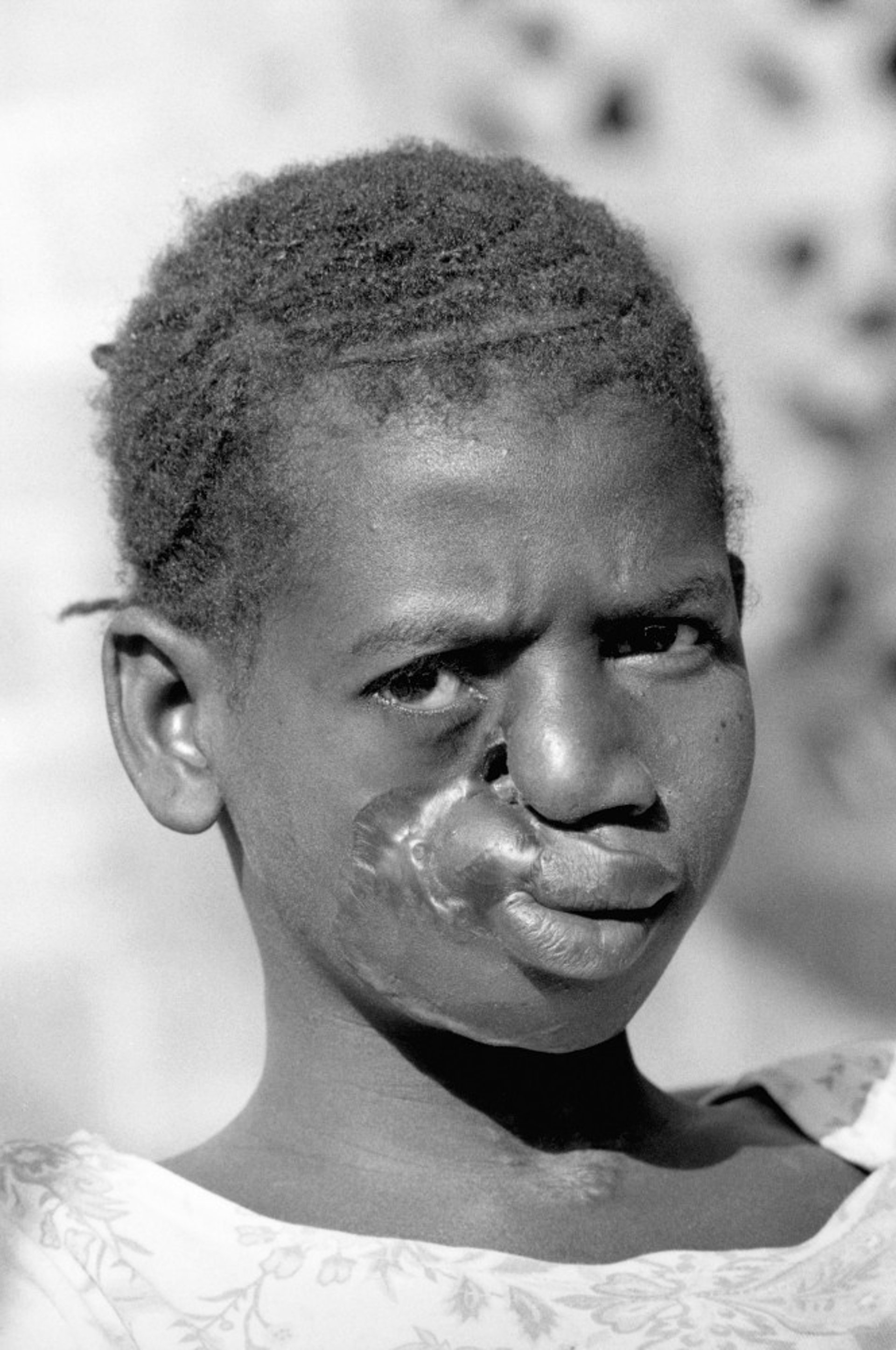 Noma (Gangrenous Stomatitis)