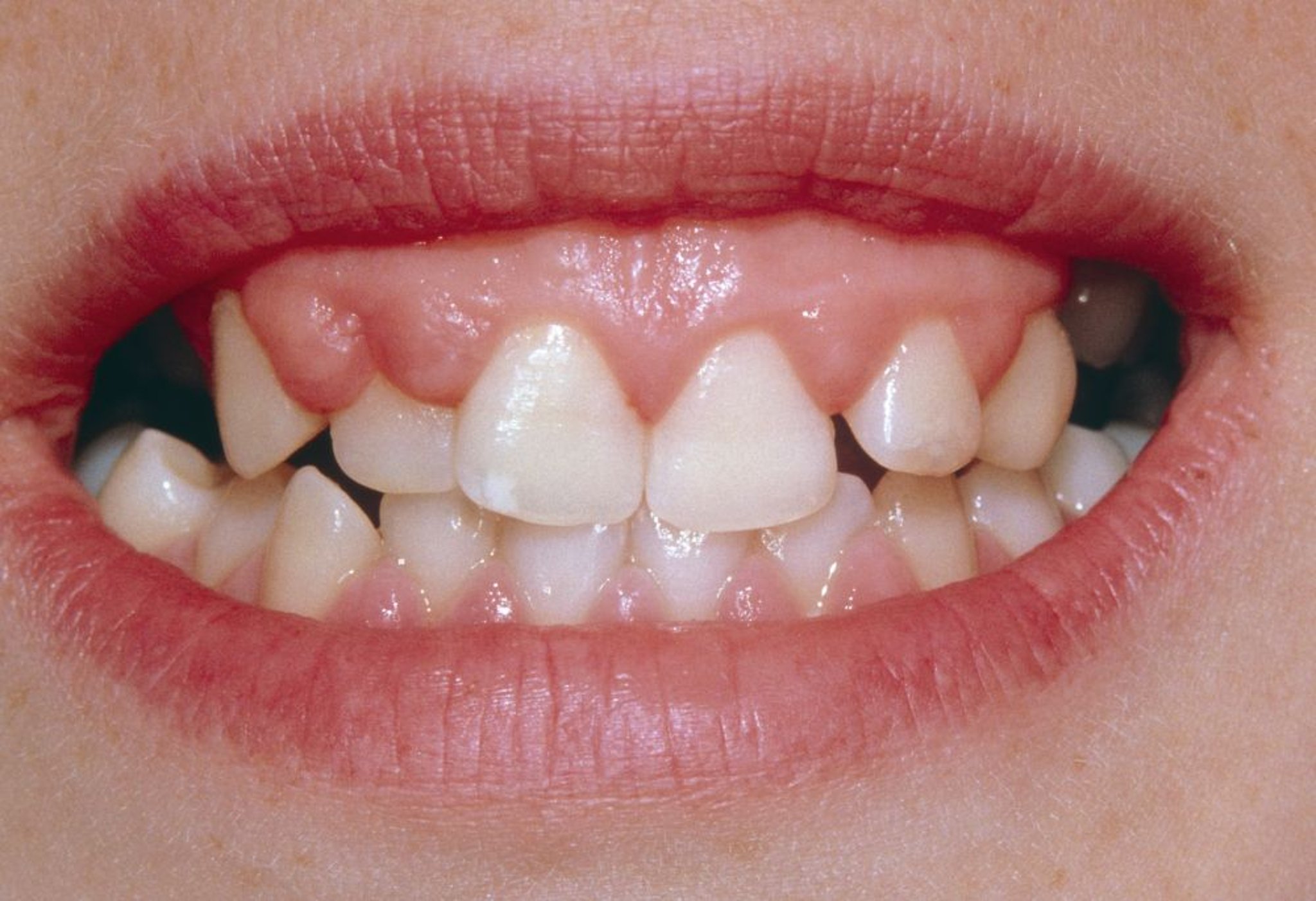 Zahnfleischhyperplasie