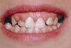 Hiperplasia gingival