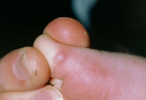 Exanthème à virus Coxsackie A (lésions des pieds)