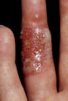Viêm đầu ngón tay do Herpes