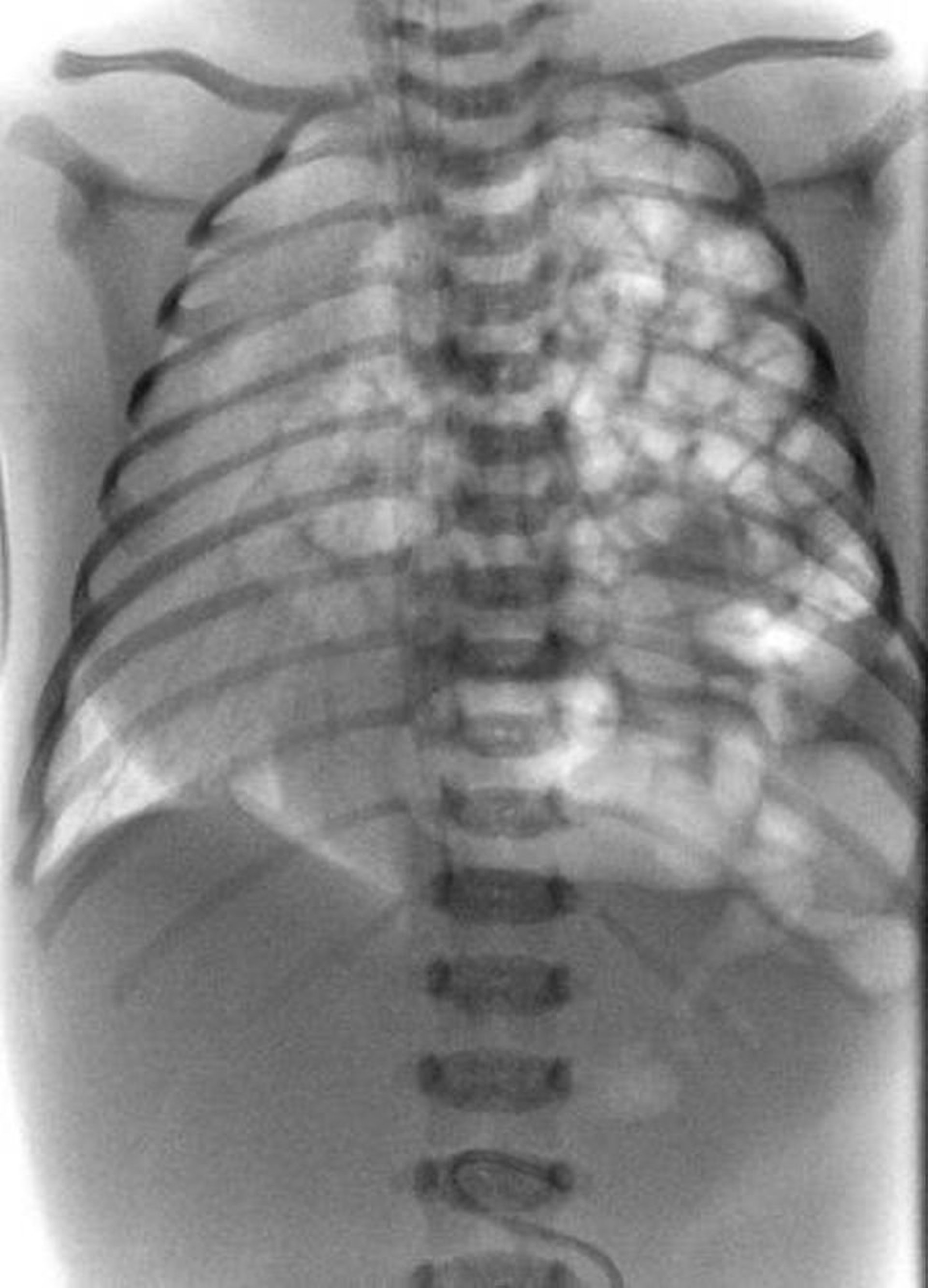 Diaphragmatic Hernia (1)