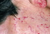 Hereditäre hämorrhagische Teleangiektasie (Rendu-Osler-Weber-Syndrom)
