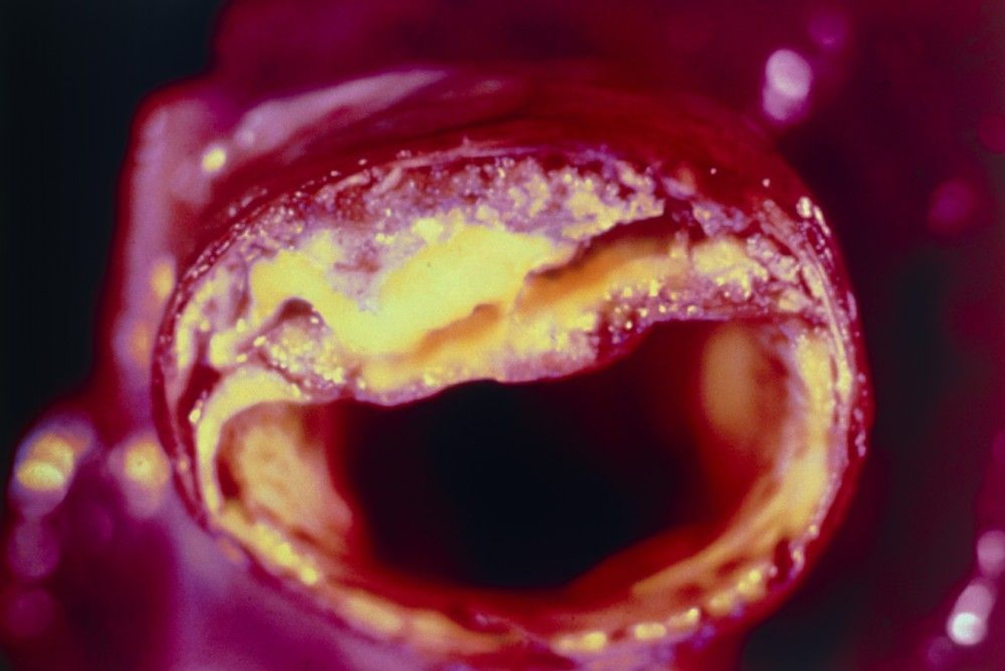 Atherosclerotic Plaque