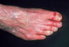 Arteriopatia periferica, cambiamenti cutanei