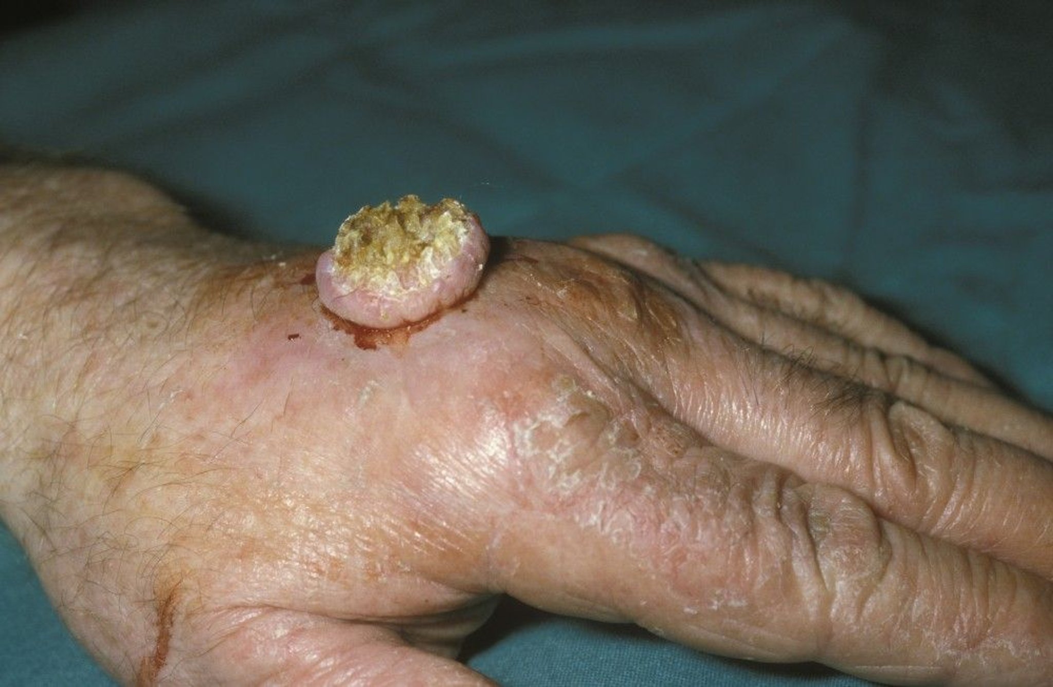 Large Keratoacanthoma