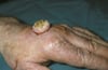 Large Keratoacanthoma