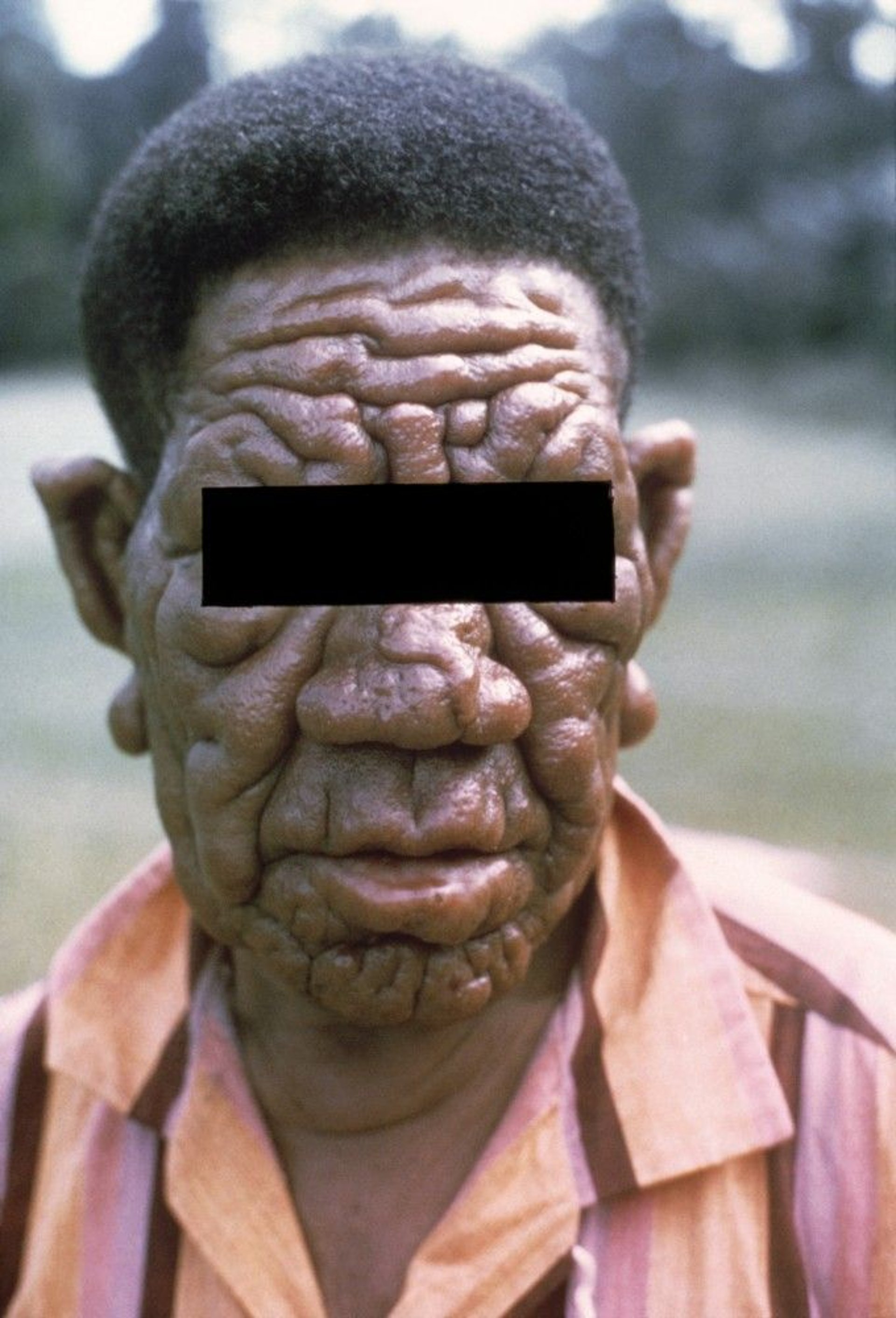 Lepromatous Leprosy