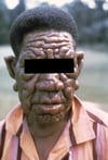 Lepra lepromatosa