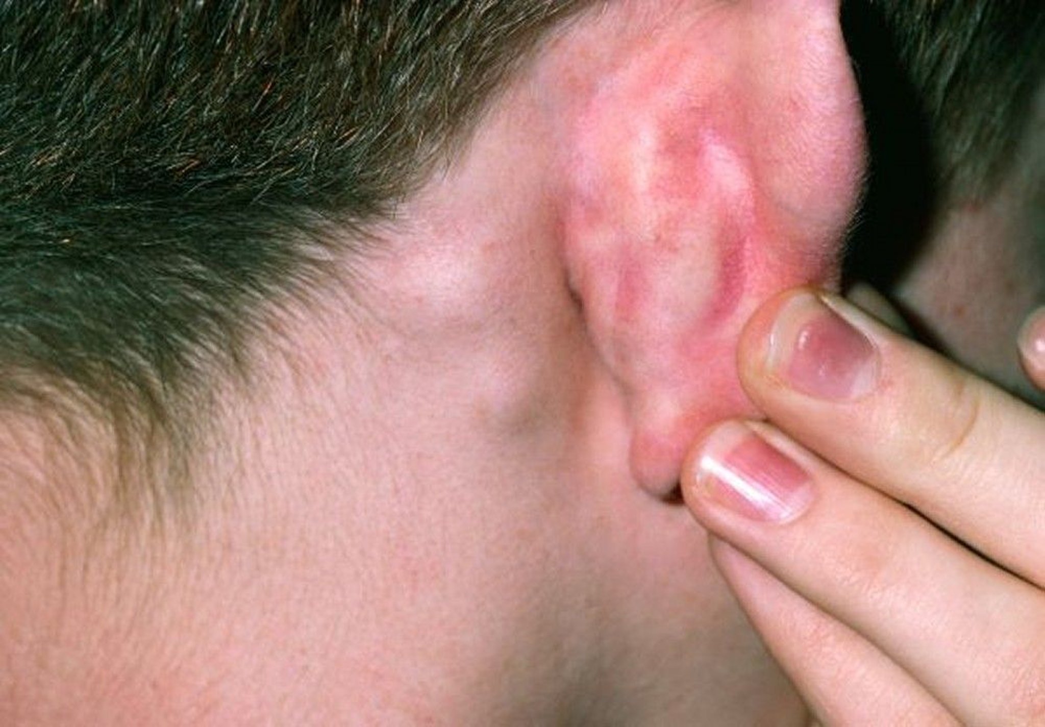 Rubella (Lymphadenopathy)