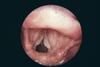 Laryngitis