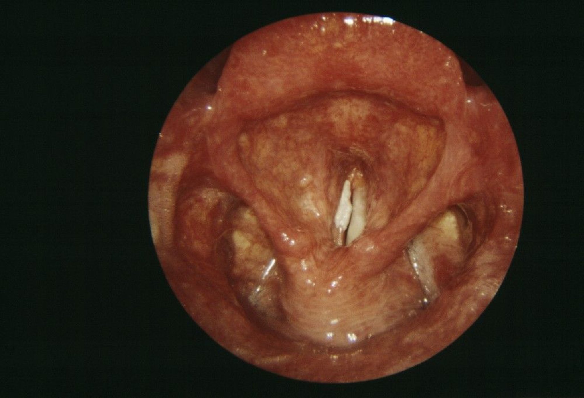 Laryngitis (Chronic Effects)