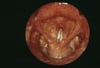 Laryngitis (chronische Effekte)