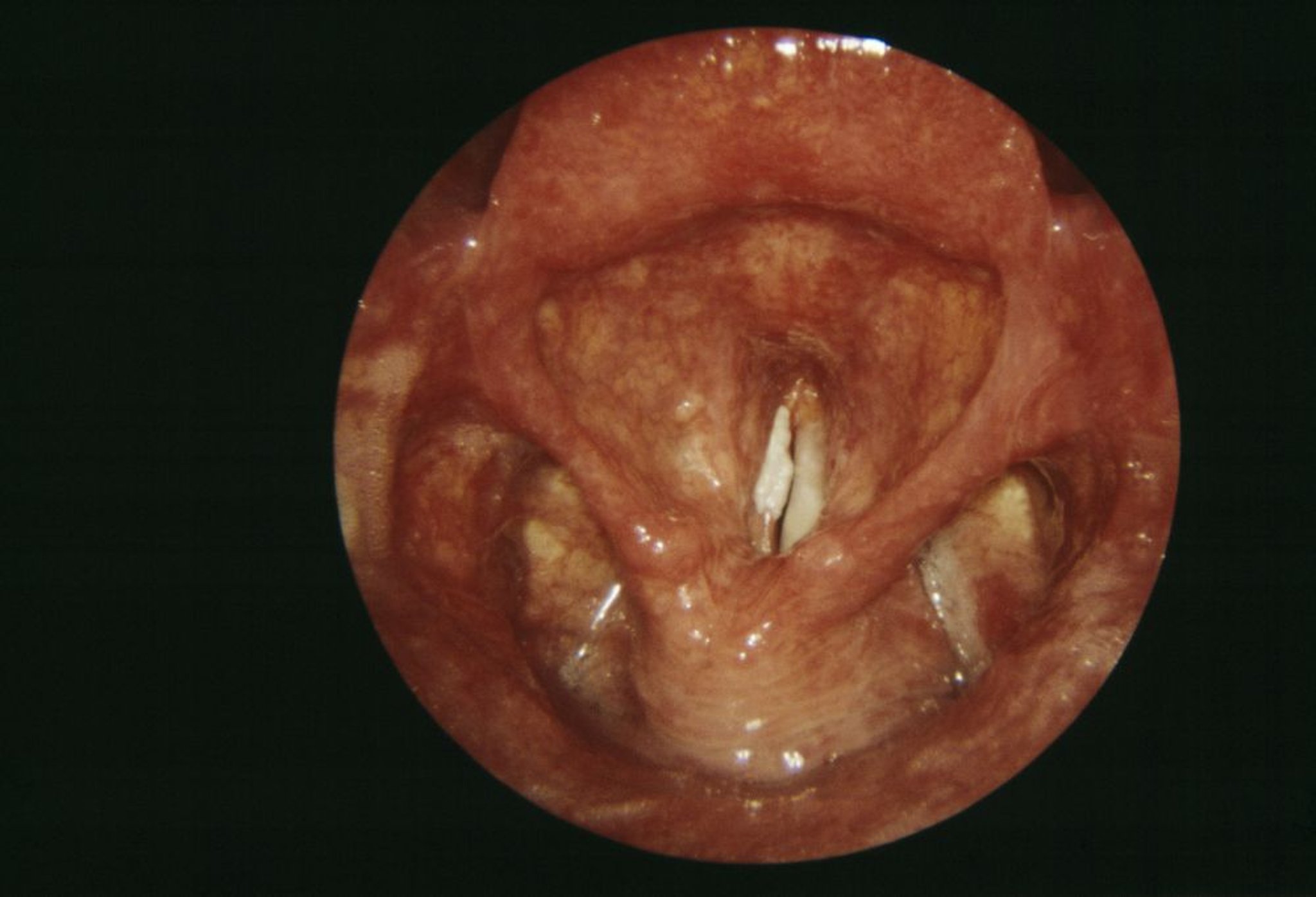 Laringite (efeitos crônicos)