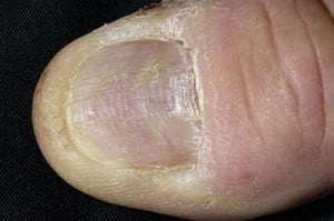 Lichen plan de l'ongle