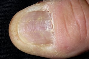 爪扁平苔癬