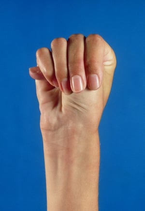 Síndrome de Marfan (signo del pulgar)