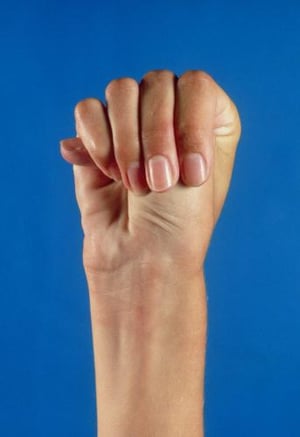 マルファン症候群（thumb sign）