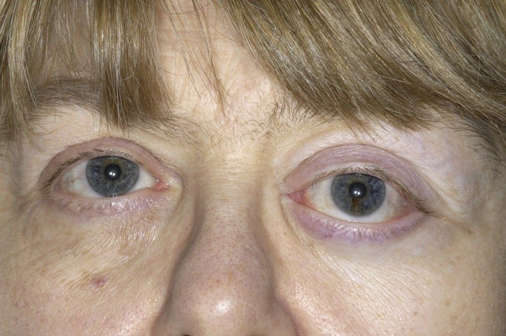 Proptosis Due to Meningioma