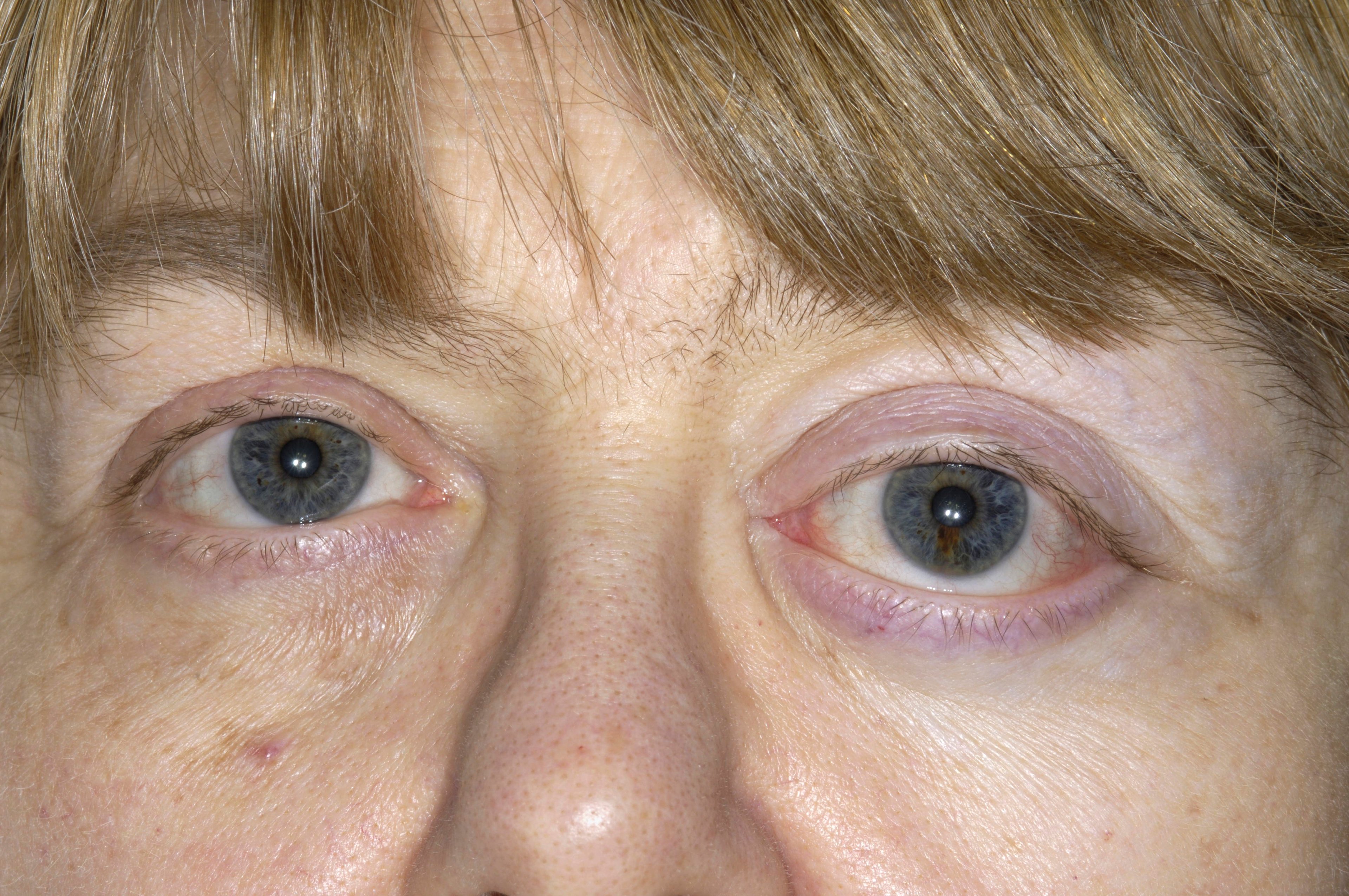 髄膜腫による眼球突出