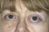 Proptosis Due to Meningioma