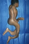 Osteogenesis imperfecta (Skelettbefunde)