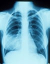 Pneumonie du lobe moyen droit avec signe de la silhouette